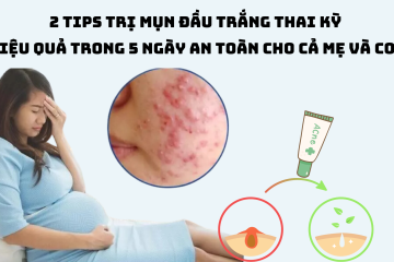 2 Tips trị mụn đầu trắng thai kỳ hiệu quả trong 5 ngày an toàn cho cả mẹ và con