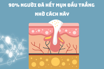 90% người đã hết mụn đầu trắng nhờ cách này