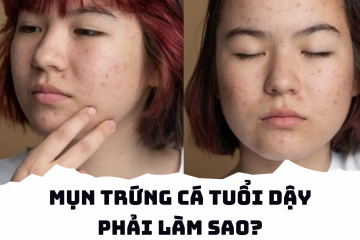 Bạn đang không biết cách trị mụn trứng cá tuổi dậy thì tận gốc như thế nào? Hãy CLICK VÀO ĐÂY!
