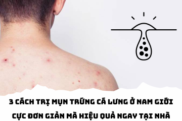 Bỏ túi ngay 3 cách trị mụn trứng cá lưng ở nam giới cực đơn giản mà hiệu quả ngay tại nhà