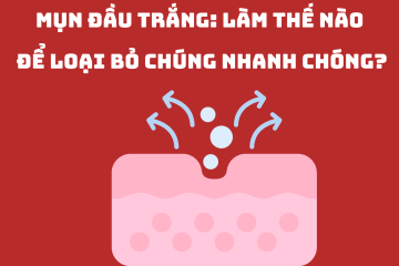 Mụn đầu trắng: Làm thế nào để loại bỏ chúng nhanh chóng?